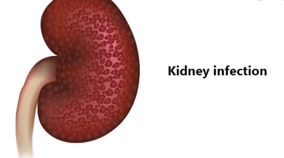 Kidney infections