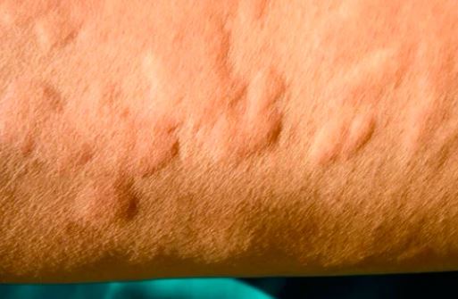 Ways to treat skin allergy by natural ways | Skin allergies