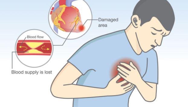 Symptoms of a heart attack – How to save your life